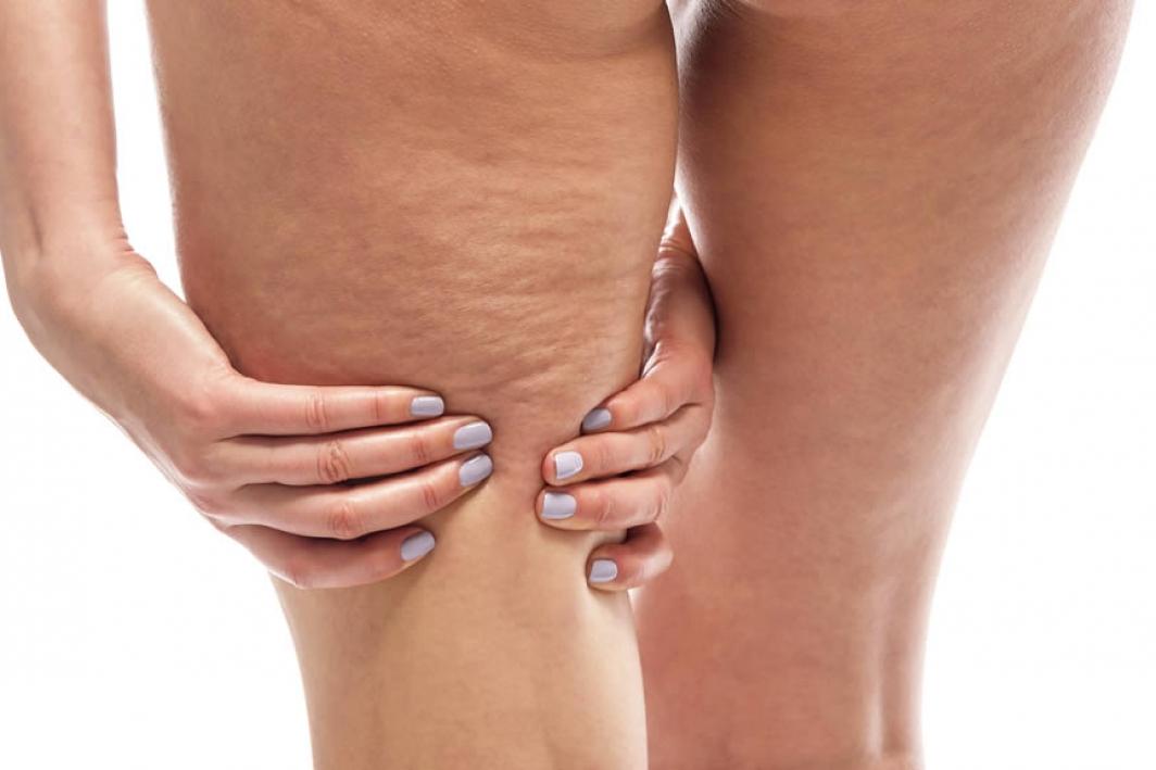 cellulite.jpg